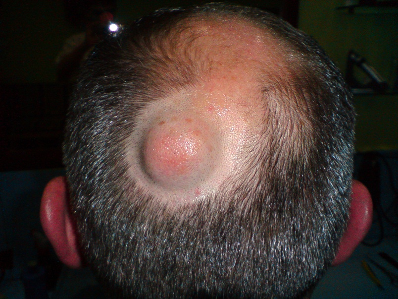 Le lichen rose ou le psoriasis de la photo